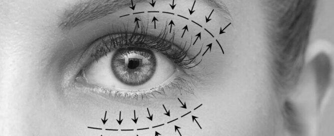 Blefaroplastia