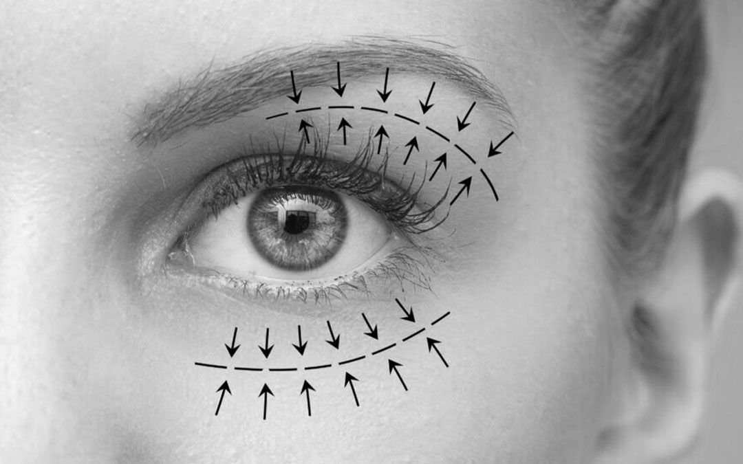 Blefaroplastia