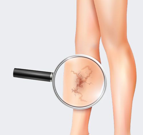 ESCLEROSIS VASCULAR